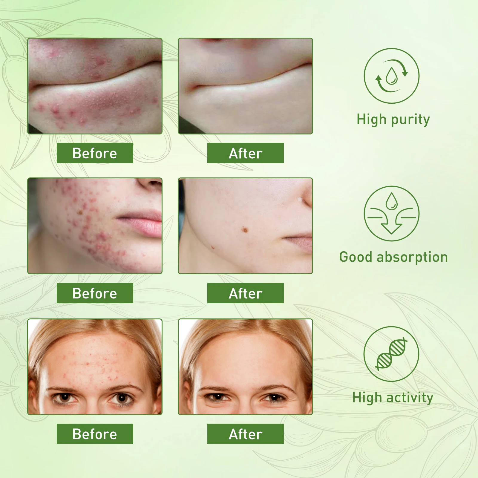 

Acne Removing Essential Oil Facial Treatment