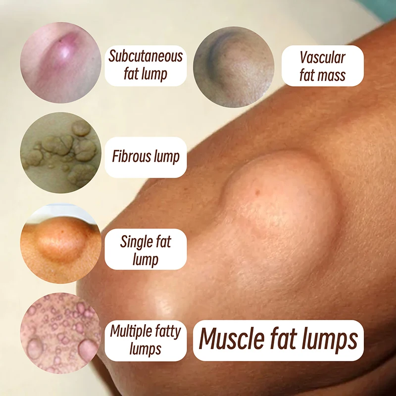 Kalmerende Crème Subcutane Brokken Remover Behandeling Geneeskunde Vloeistof Toepassen Op Huid Zwelling Cellulitis Fibroma Vet Massa Gips