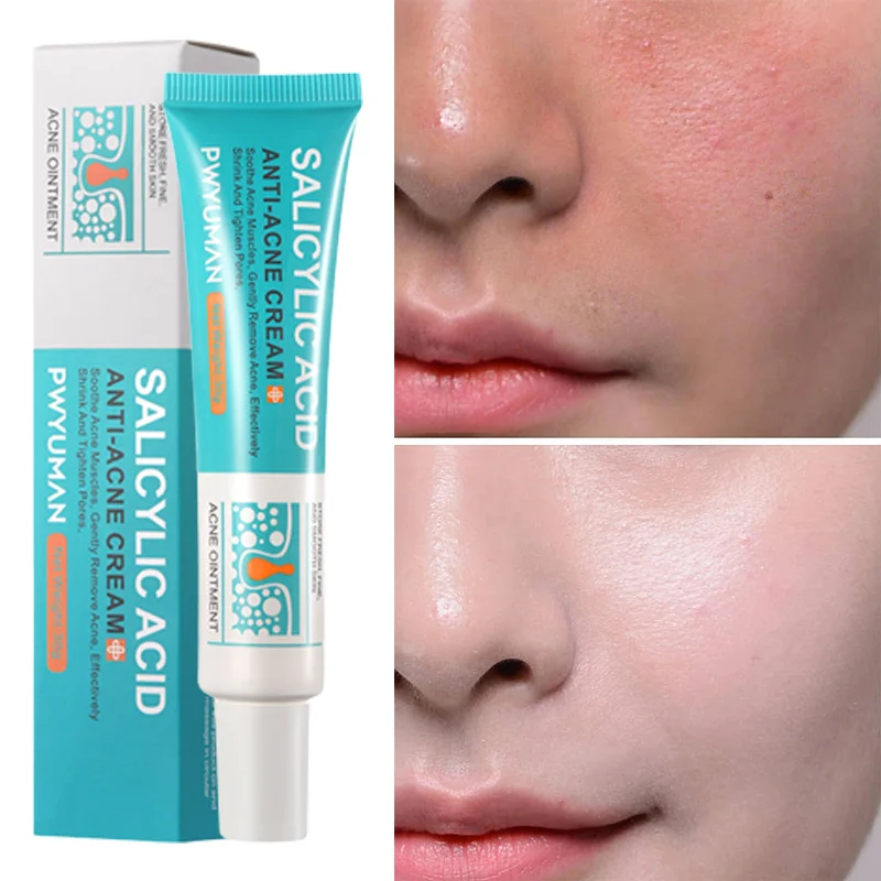 Salicylic Acid Night Cream Clean Pores Exfoliation Gel Reduce Redness Acne Marks Pigmentation Oil Control Repair Face Skin Care