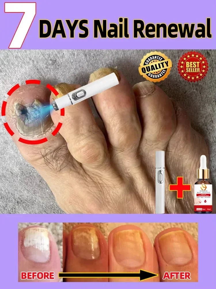 Laser Product For Solving Nail Problems