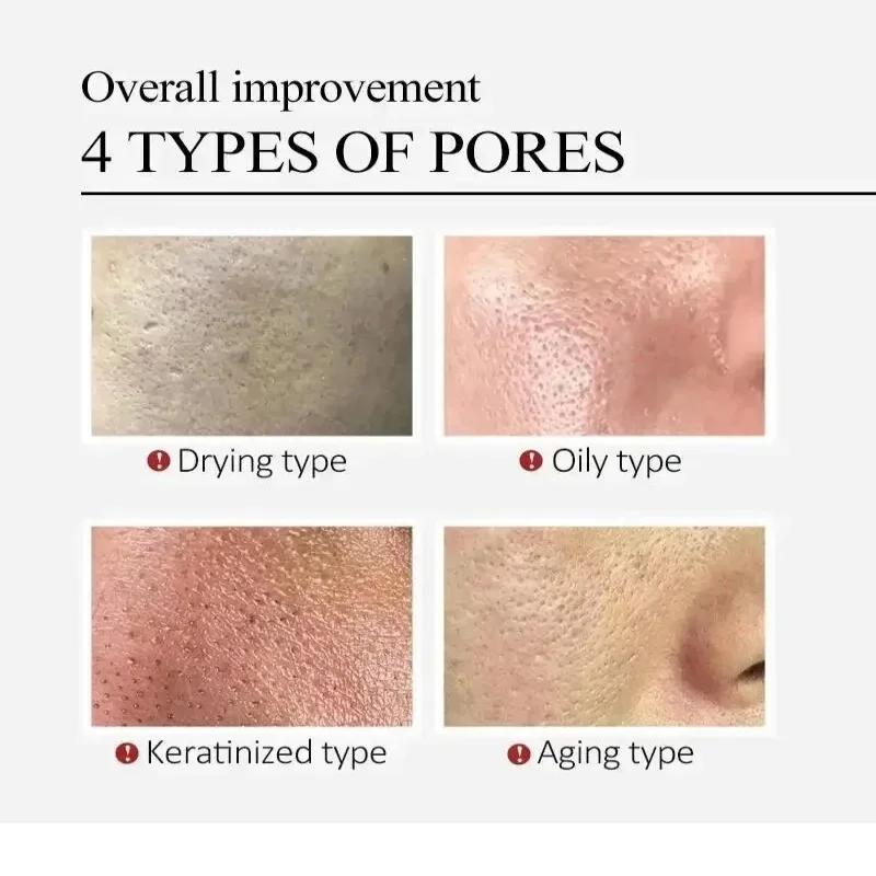 حمض الساليسيليك كريم تكرير المسام تقليص المسام Lmprove تبييض مكافحة الشيخوخة كريم الوجه حب الشباب كريم 20 جرام العناية بالبشرة #2