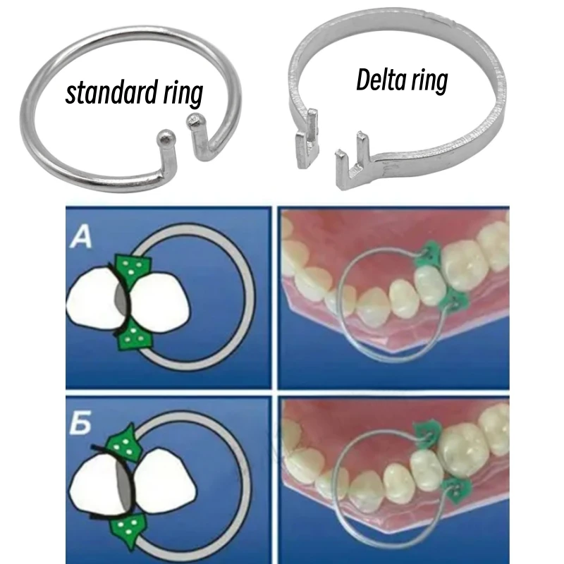 100Pcs Dental Sectional Contoured Matrix Bands Wedges Metal Clamping/Seperating Rings for Teeth Replacement Dentist Tools