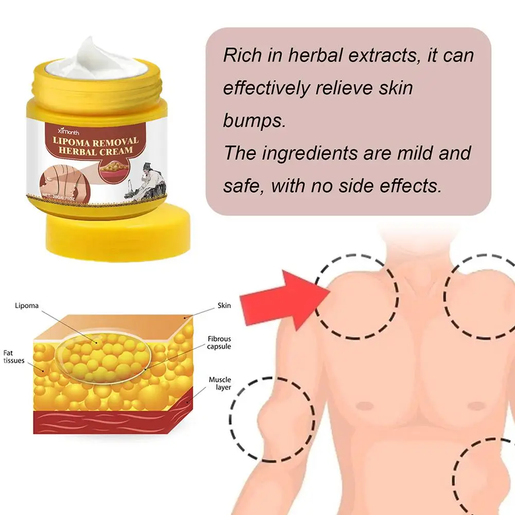 3pcs Lipoma Removal Cream Treatment Skin Swelling Lipolysis Fat Lump Cellulite Elimination Lump Nodule Smoothing Ointment