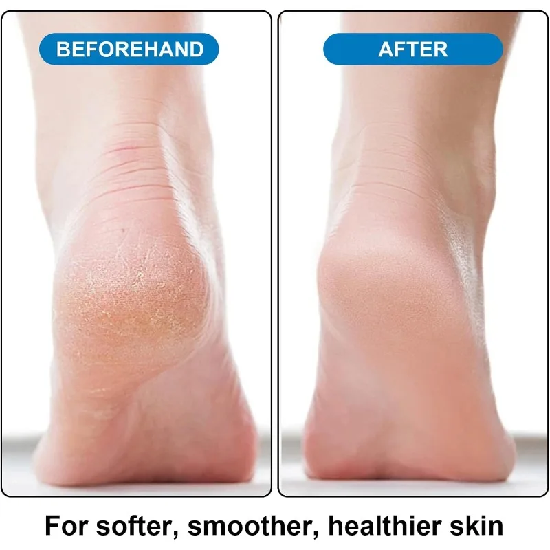 Éponge en pierre ponce pour les pieds, dissolvant de callosités, élimine les peaux mortes dures et craquelées, pieds lisses, outil exfoliant doux, 1/2/4 pièces