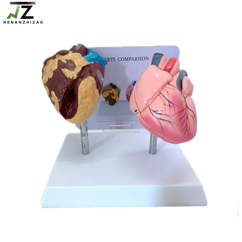 

Smoking and Healthy Heart Comparison Pathological Model