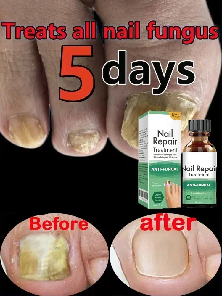 NewToenail Nail Fungus Treatment Repair Fingernail Device Toenail Treatment for Foot Nail Fungus Essential Oil Onychomycosis Ca