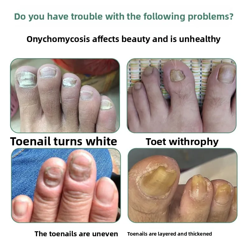 

Лечение грибка ногтей с экстрактом трав — восстанавливает утолщенные, обесцвеченные и хрупкие ногти. Восстановите здоровые ногти на ногах.