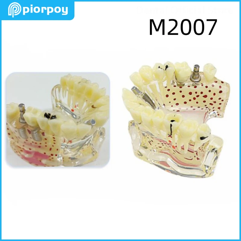 Dental Implant Models Maxillary Dentistry Education Teeth Teaching Mold For Demonstration Students Practice Products M2007