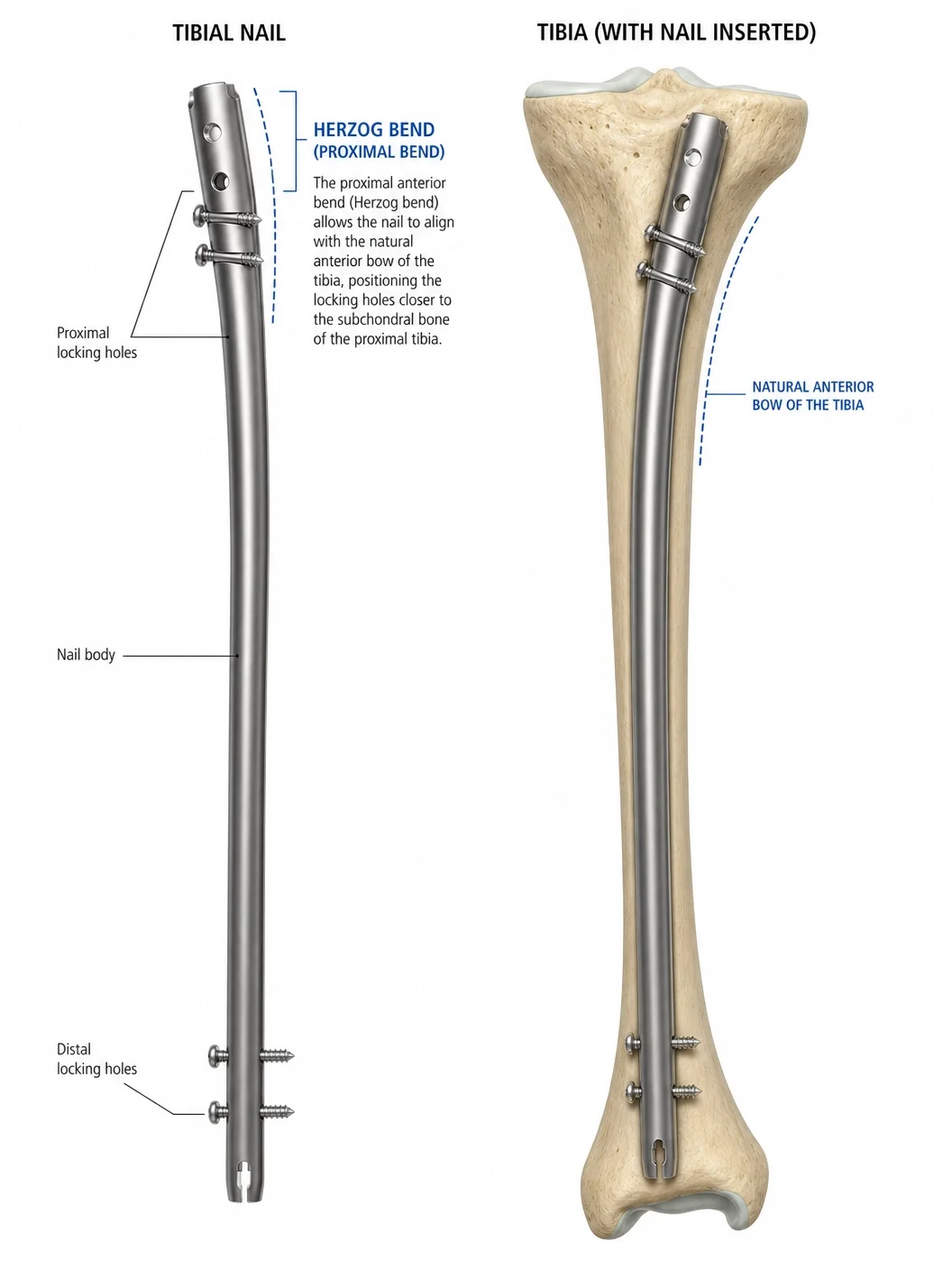 Well Trust Tibial Interlocking Nail Intramedullary Cannulated Orthopedic Implant Kit CE Certified For Orthopedic Surgery