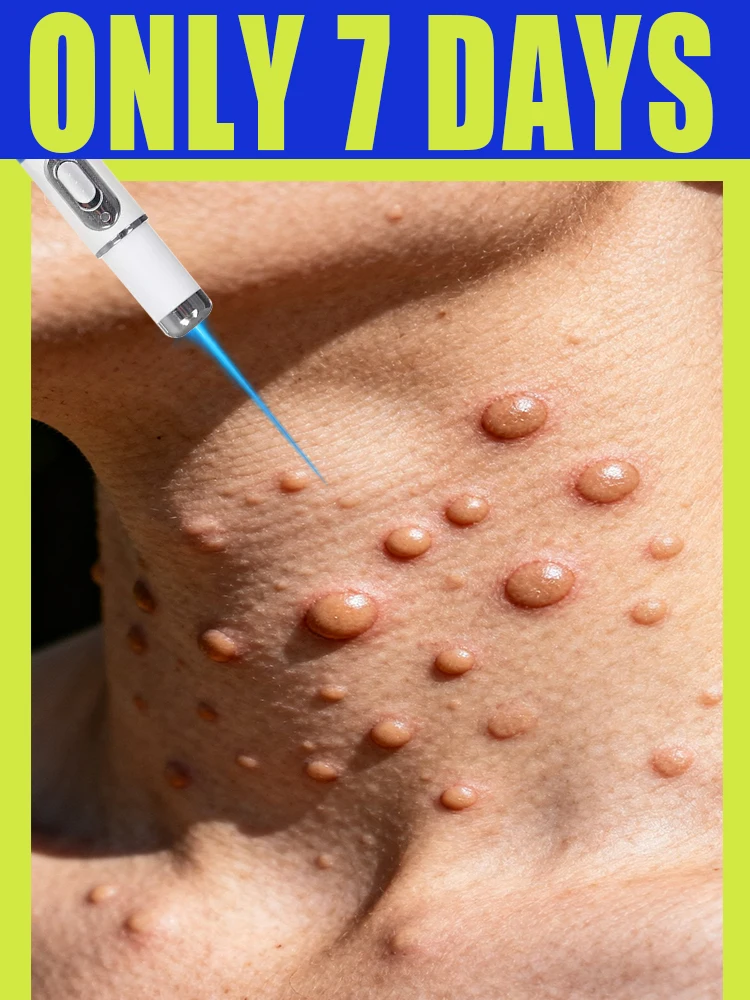 

Blue Laser pen removal Wart Tool at home used take care off wart gentlely for skin