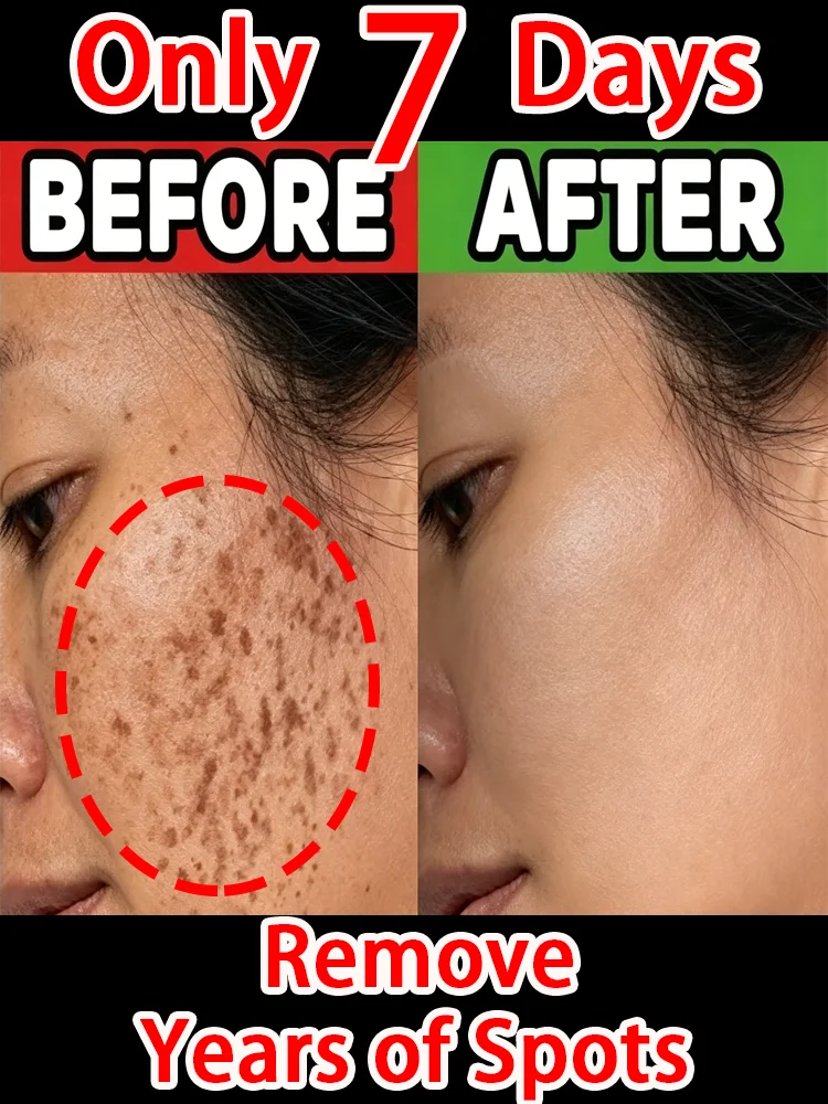 

Устраняет отложения меланина и быстро осветляет тон кожи.