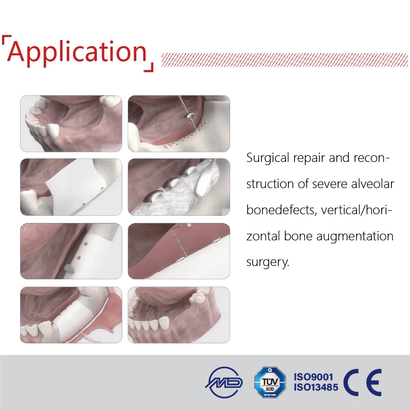 Shuangyang New Products Dentl Gbr Master Kit for Denta Implans CE ISO Certified Class III