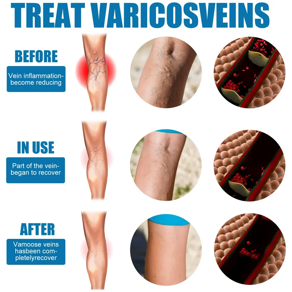 30ml Varicose Vein Spray Vasculitis Phlebitis Spider Legs Smoothing Blood Vessel Bulging Treatment Redness Leg Body Care