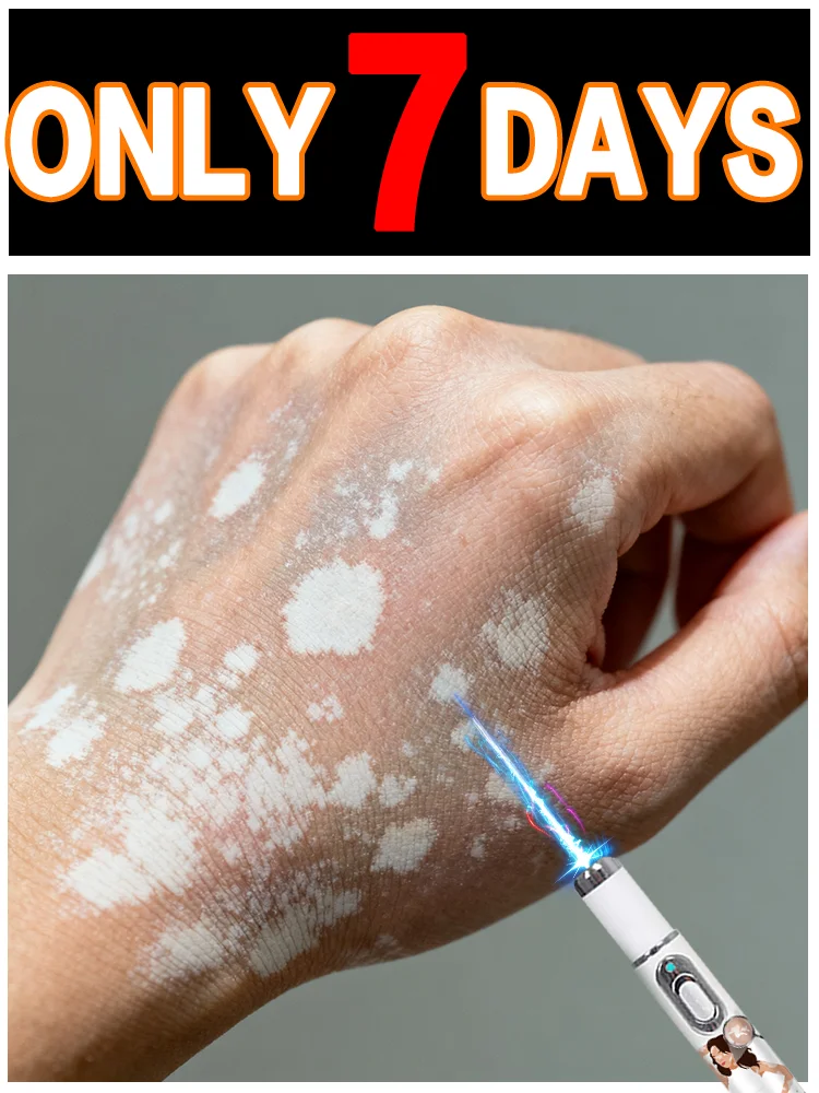 白斑の症状ケアに最適なヘルパー！ ブルーライト補助ツールとブルーペンは、正確なケアと優しいスキンケアを提供します。