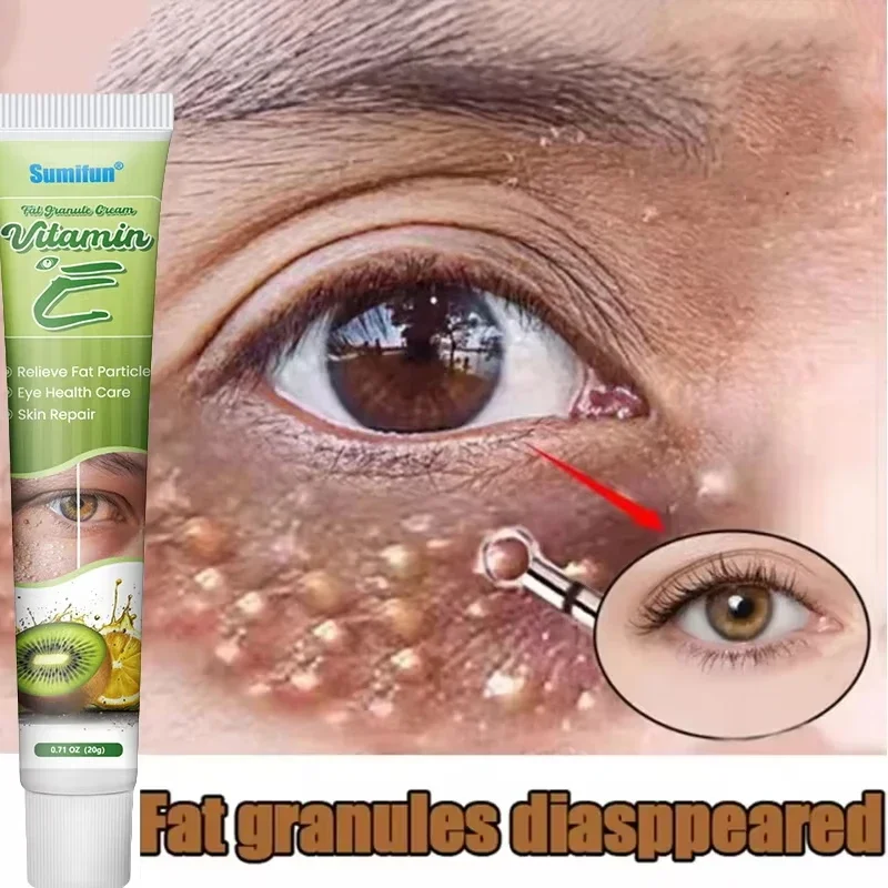 

Fat Granules Remover Eye Cream Effective Remove Fat Granules Puffiness Anti-Particles Milia Remover Product Repair Eye Skin Care