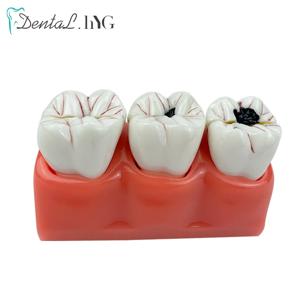 4:1 Size Dental Caries Removable Teeth Tooth Model Learn Study Model Dentist Education 3pcs Teeth