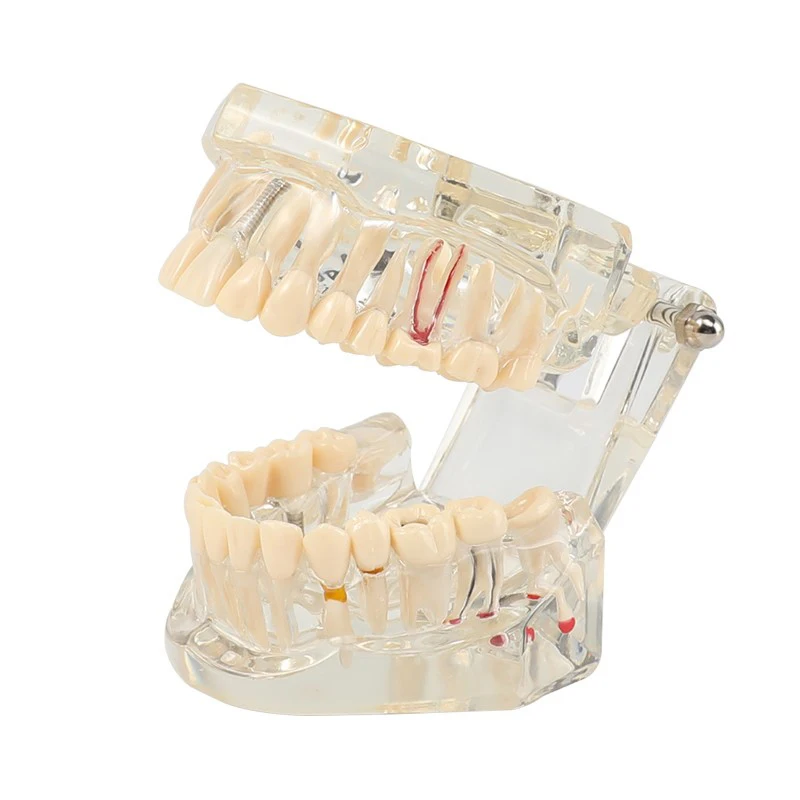Dental Models Oral Implant Restorative Pathology Demonstration