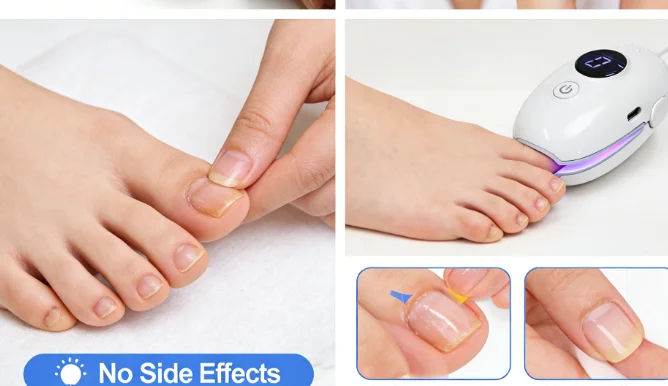 

Домашний лазерный аппарат для лечения грибка ногтей – альтернатива пероральным противогрибковым препаратам, без побочных эффектов, без частых посещений клиники.