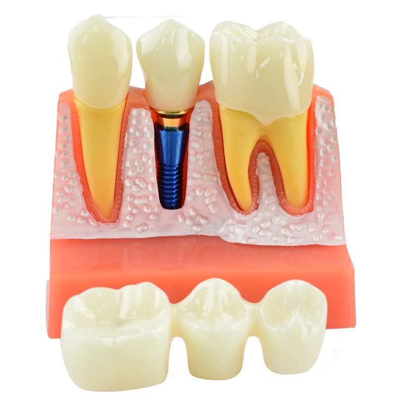 

Dental Model Analysis Crown Bridge 4 Times Implant Demonstration Removable Model Dentist Teaching Model