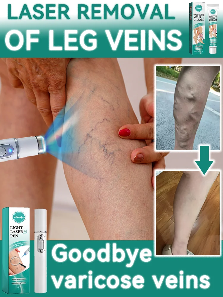 Laser product to eliminate bulging blood vessels in legs