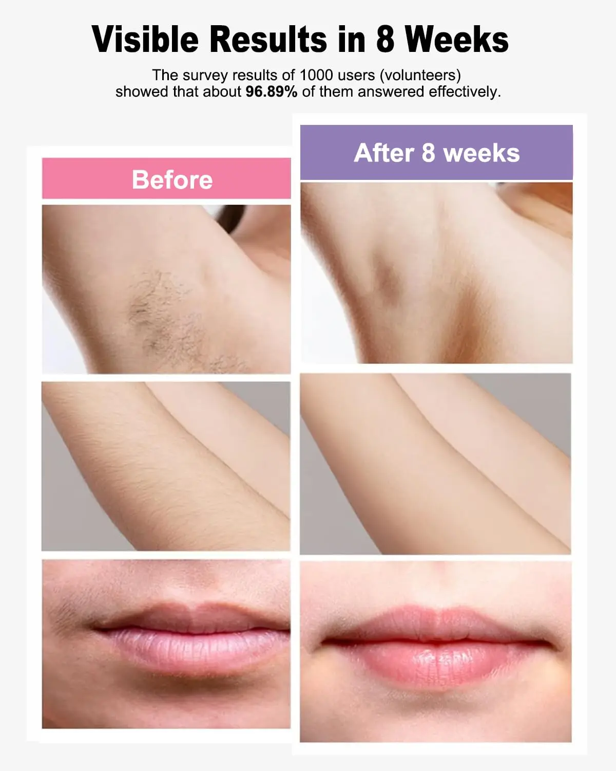 جهاز إزالة الشعر بالليزر IPL للنساء والرجال، 999,999 ومضة، آمن وفعال للوجه والذراعين والساقين ومنطقة البيكيني - للاستخدام المنزلي