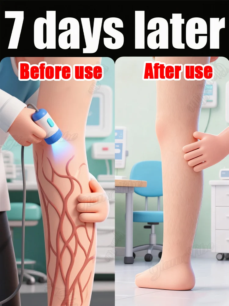 

2025 Latest Blue Light Varicose Vein Laser Pointer: Hot Selling Leg Tool
