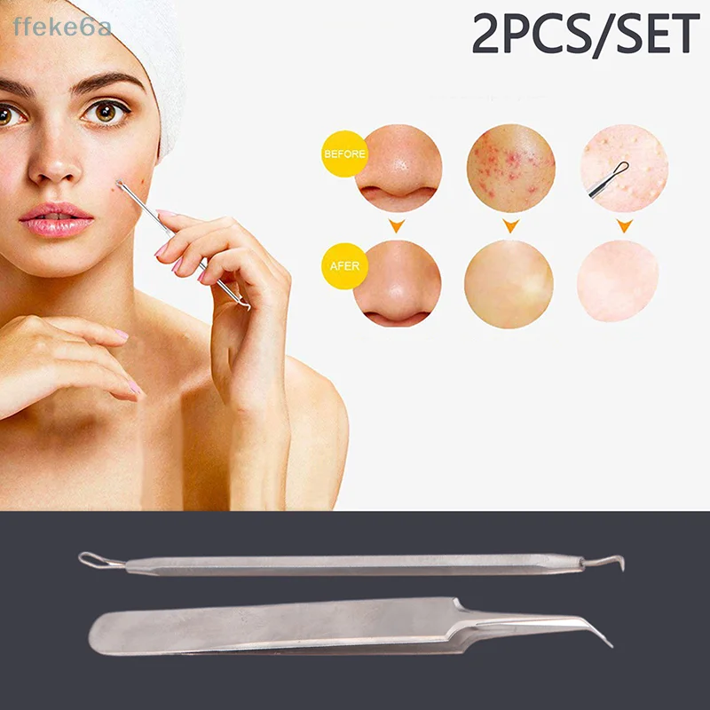 2 pçs/set removedor de cravo comedone acne vara extrator espinhas para rostos pontos pretos pinças beleza facial cuidados com a pele ferramentas