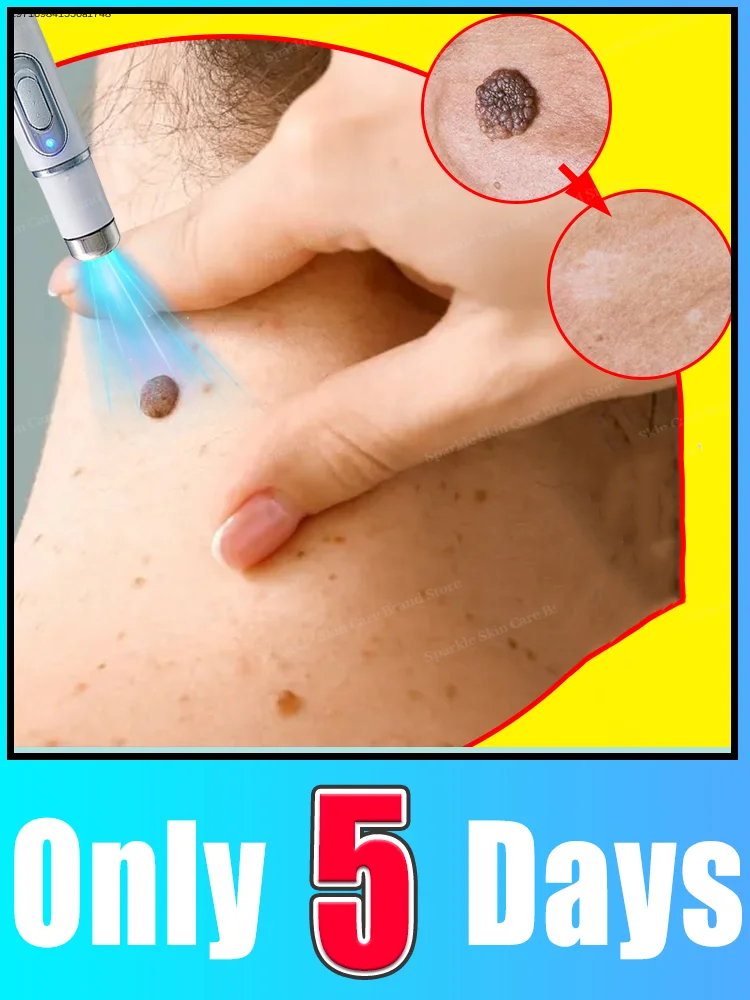 

Лазер второго поколения, который раскупается как горячие пирожки, избавляет от всех бородавок за 7 дней.