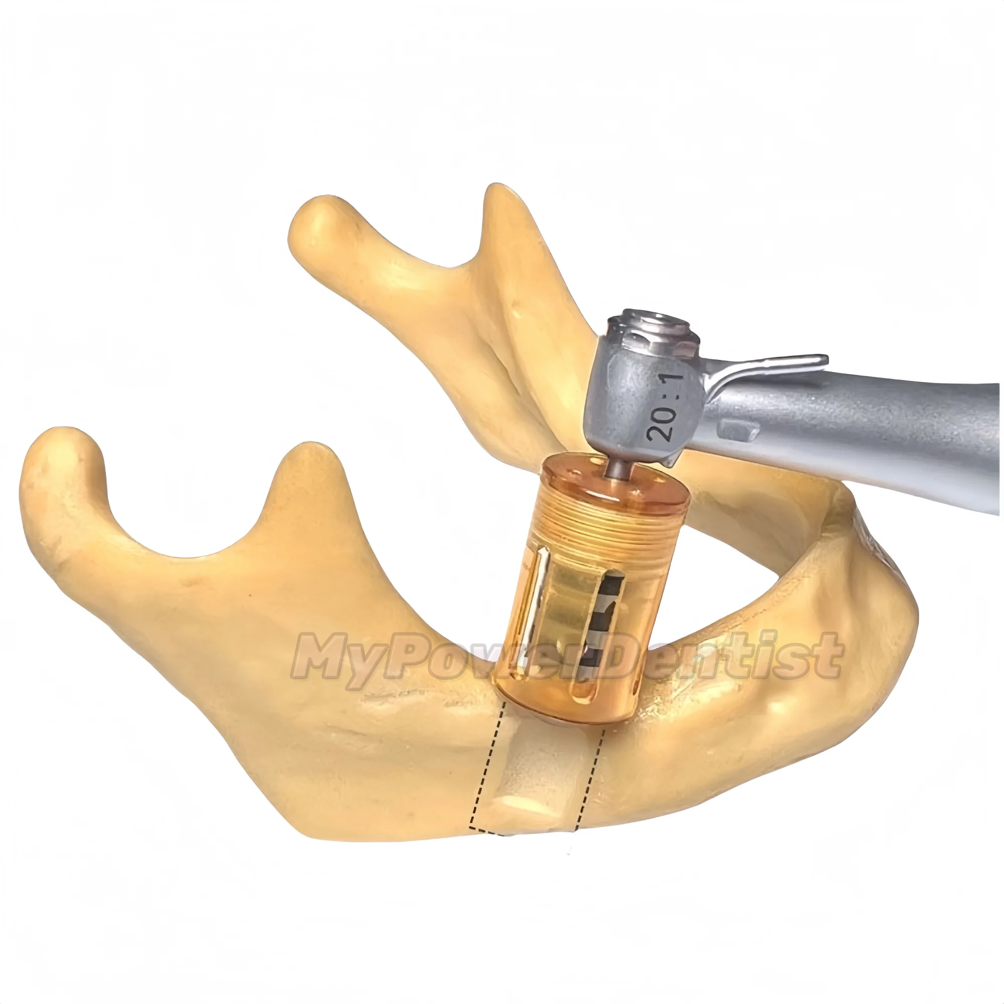 Dental SLT Half Moon Bone Harvest Drill Semilunar Technique Collector Drills 8.0/9.0/10.0mm