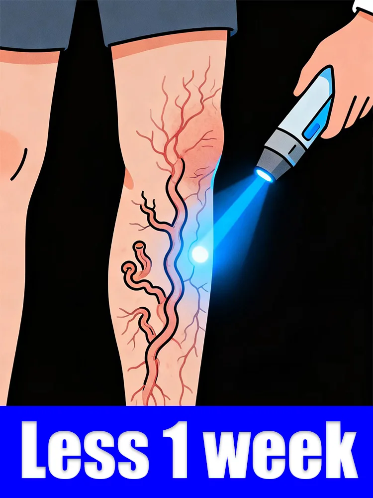 

Blue light pen to relieve various varicose vein problems at the root