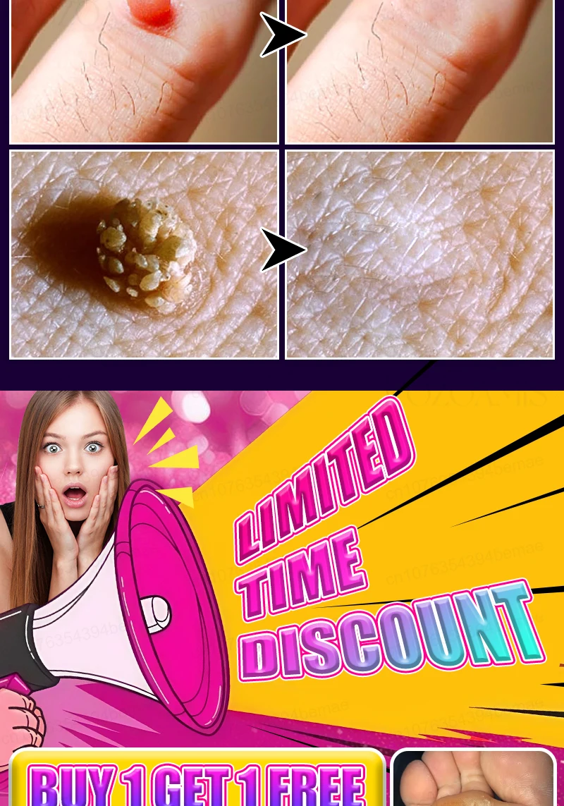 

Blue light pen to solve warts, hot selling wart care tool