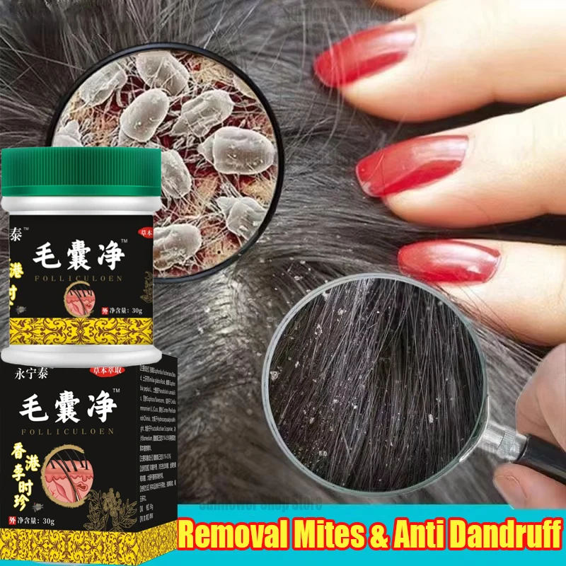 

Fast Anti Exfoliating Scrub Remove Dandruff Anti Itching Treatment Seborrheic Scalp Oil Control Repair Scalp Beauty Health Care