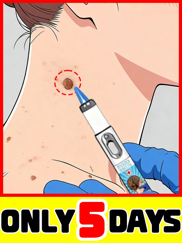 

Лазерная ручка для удаления бородавок, безболезненный опыт, последовательно бестселлер.