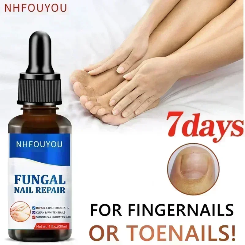 HOT~NewNail Fungus Treatment  Serum Toe  Fungal Repair Products  Hand Foot Care  Removal Gel Anti Infection Paronychia Onychomyc