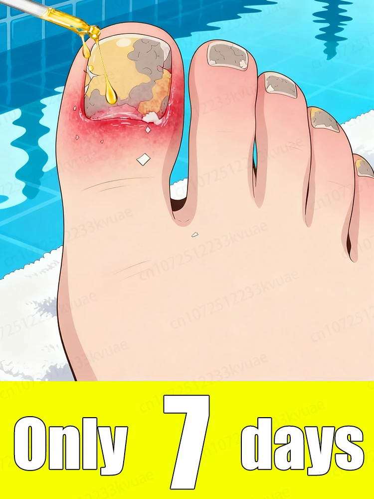 

Don't let ɴᴀɪʟ ғᴜɴɢᴜs affect your life. Say goodbye to onychomycosis in 7 days.
