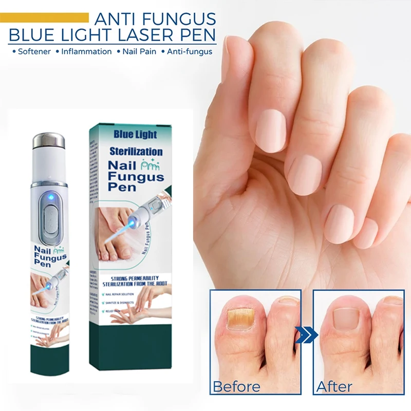 Fungus Care Repair Pen Anti Fungus Blue Light Repair Pen Onychomycosis Painless Removal Foot Repair Products Laser Pointer