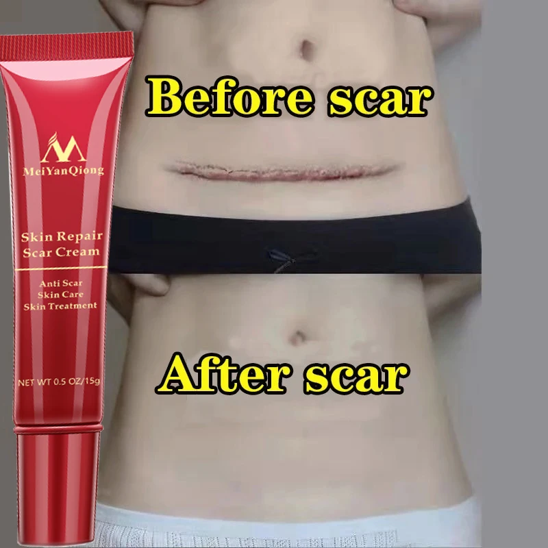 

10pcs 15g Treatment Body Scars Ointment Maternity Pregnancy Mark Repair Body Creams Acne Stretch Marks Effective Remove Dressing