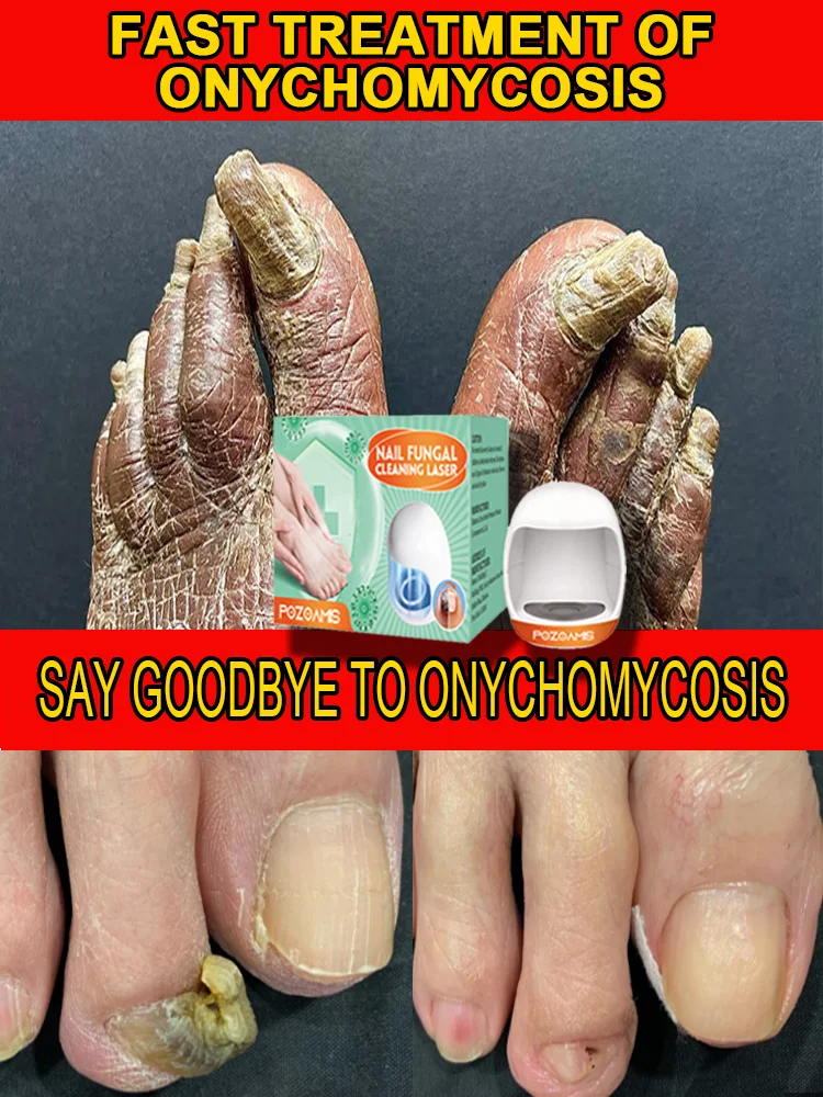 Onychomycosis treatment device Fungal nails Painless phototherapy Effective treatment