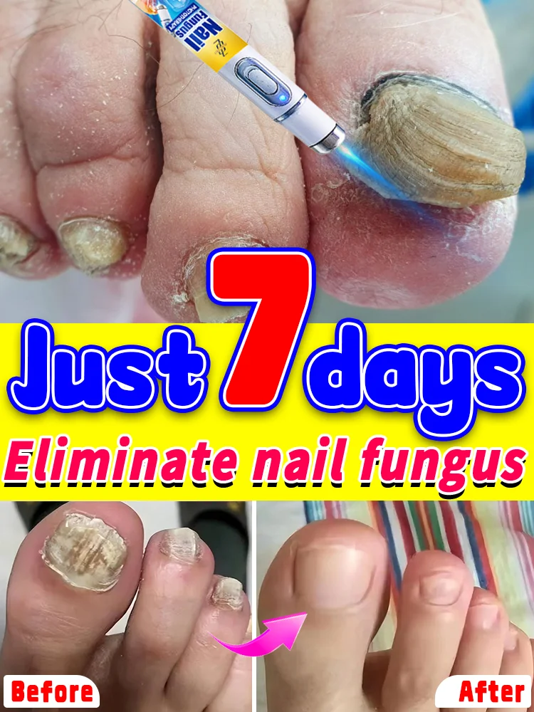 爪甲修復レーザーポインター、カビ爪が消え、爪が美しく透明に。抗菌・抗炎症効果も抜群。