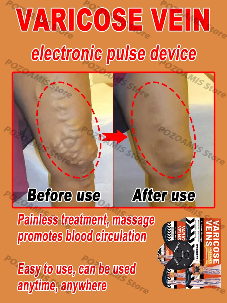 Electronic pulse machine promotes blood circulation and relieves protruding and deformed thigh blood vessels