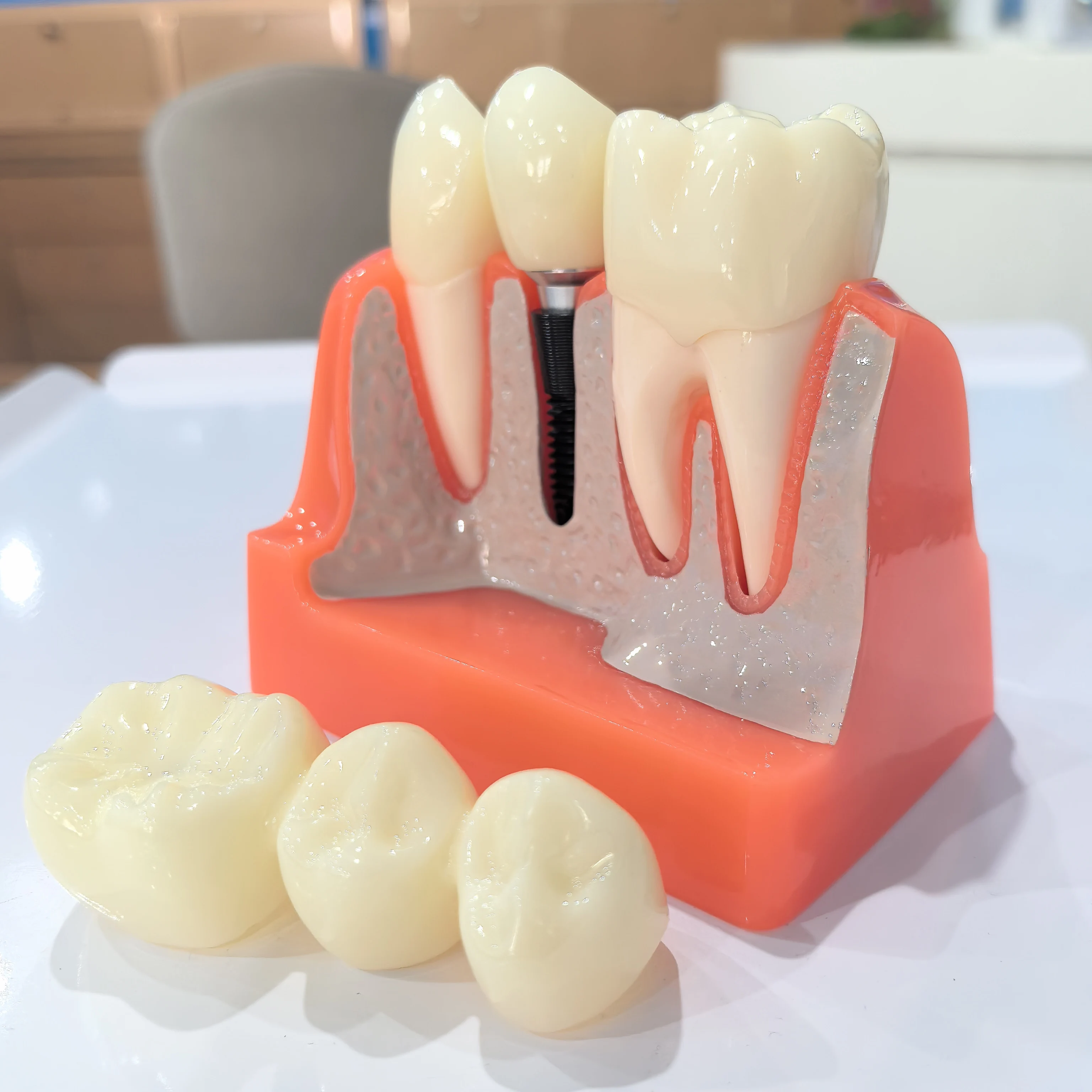 2.5 times Larger Dental Implant Restoration Demonstration Model Crown And Bridge Abutment Removable for Educational Use in Denta