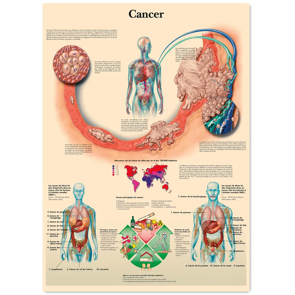 Cancer (French) Human Anatomy Posters & Prints Wall Art Vintage Kraft Paper Painting Wall Chart Hospital Clinic Room Home Decor