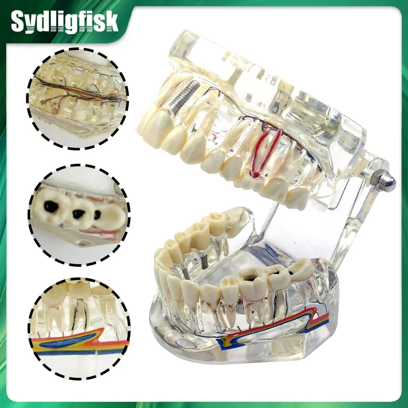 

Dental Model Teeth Neural Repair Dental Implant Pathological Model Medical Teaching Study Disease Dentist Demonstration Model