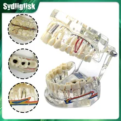 Dental Model Teeth Neural Repair Dental Implant Pathological Model Medical Teaching Study Disease Dentist Demonstration Model