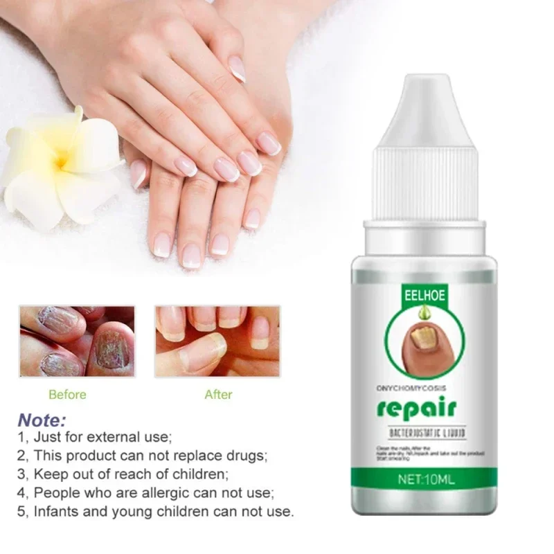 Nail Fungus Treatment Serum Repair Fungus Removal Essence Liquid Onychomycosis Foot Care Gel Anti Infection Thicken Soft Nails