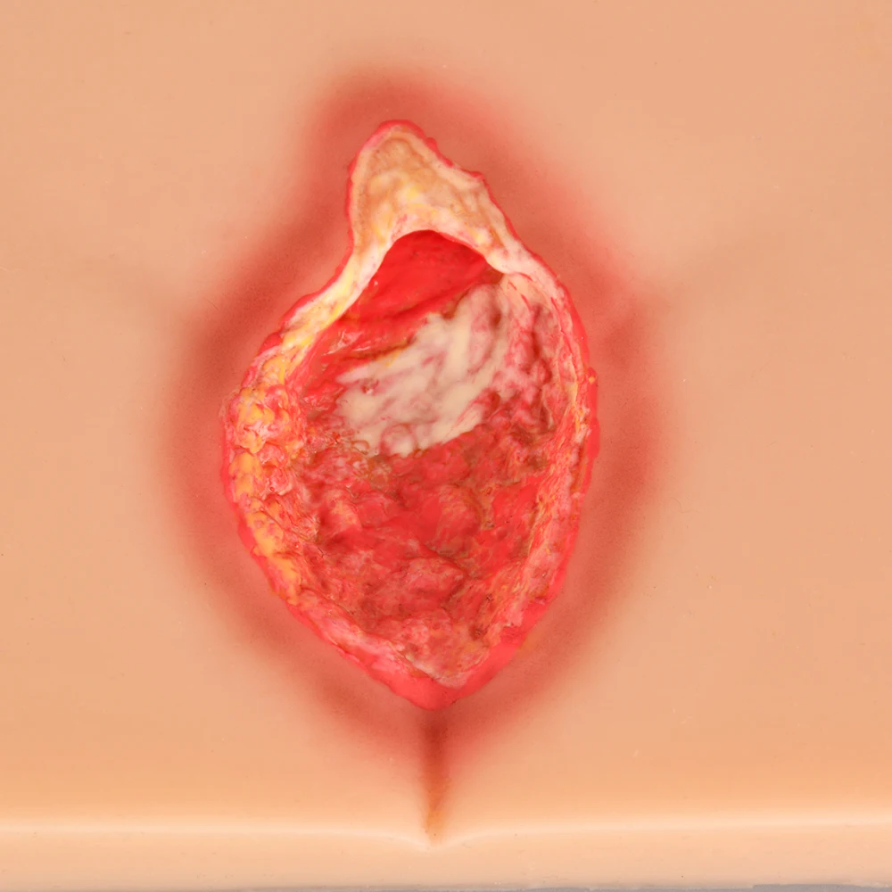 زخم ضغط السيليكون (المرحلة 1-4) نموذج تمريض مظاهرة، محاكي السيليكون، نموذج للتدريس