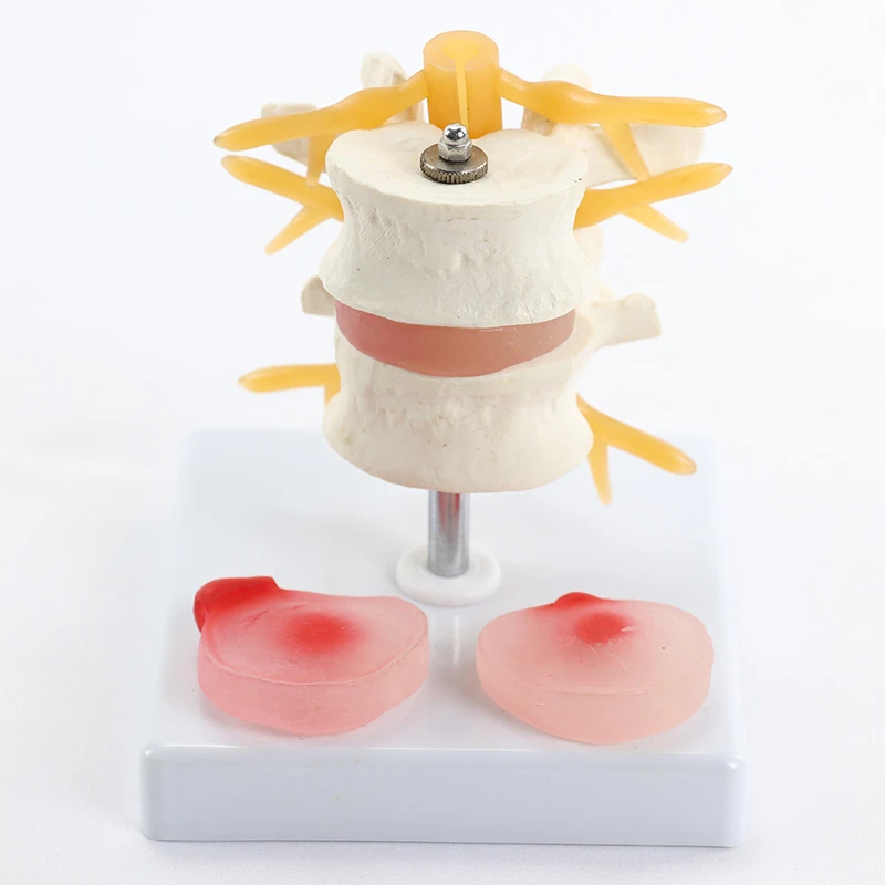 Medical Anatomical Lumbar Disc Herniation Demonstration Model Human Spine Model Classroom Supplies Teaching  Free Shipping