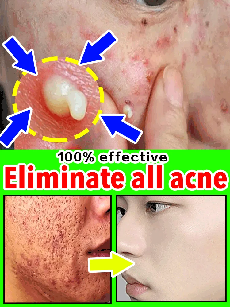 

remove acne scars face marks remedy pimple remedy