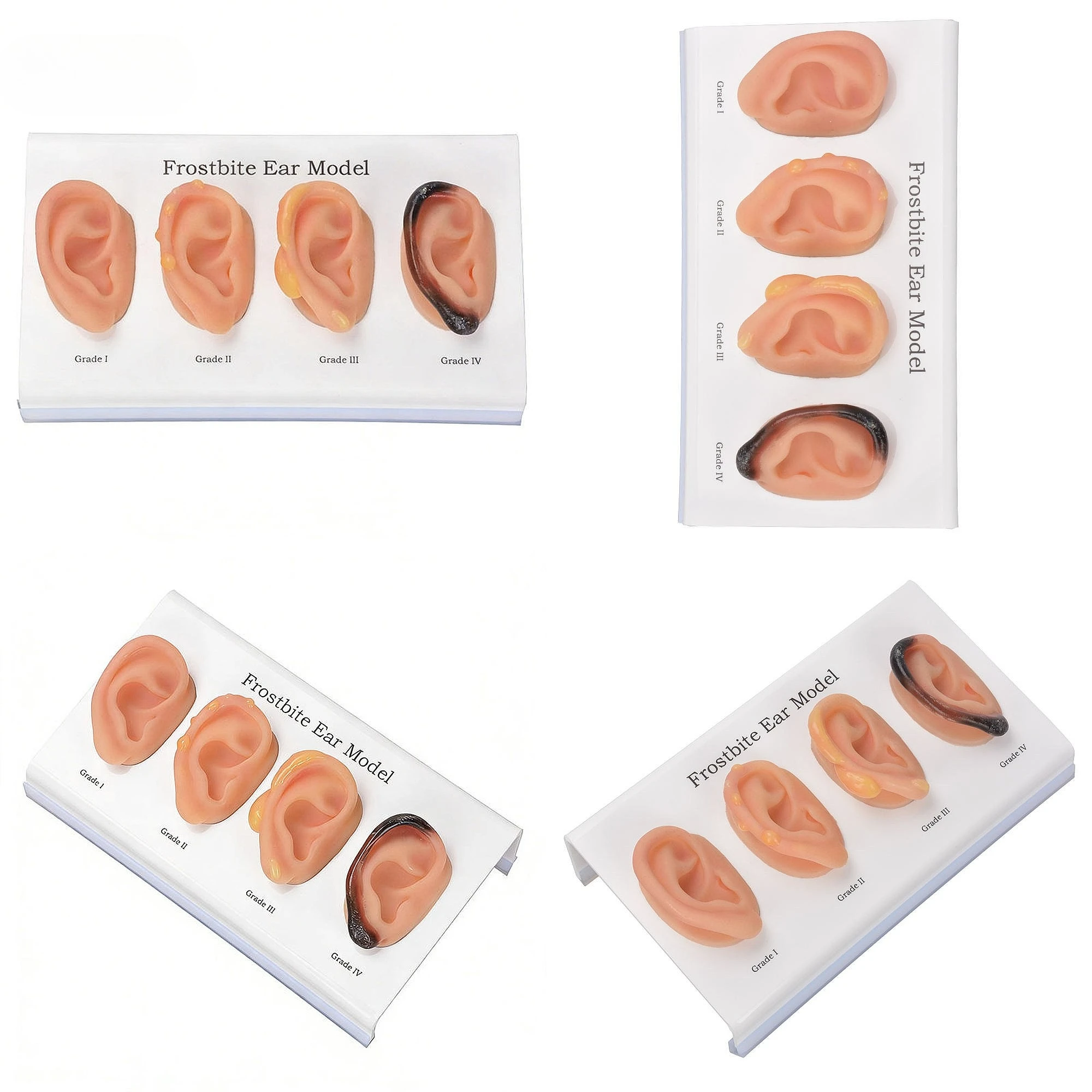 YL2-04041 High-Simulation Silicone Ear Frostbite Grading Display Model Medical Teaching Tool