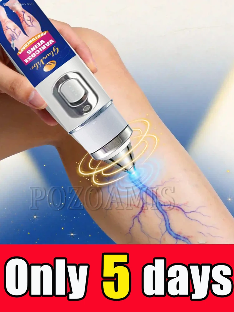 ᔆᵉᵈᵉⁿᵗᵃʳʸ ᵒᶠᶠⁱᶜᵉ ʷᵒʳᵏᵉʳˢ Blue light pen helps people with bulges on their legs
